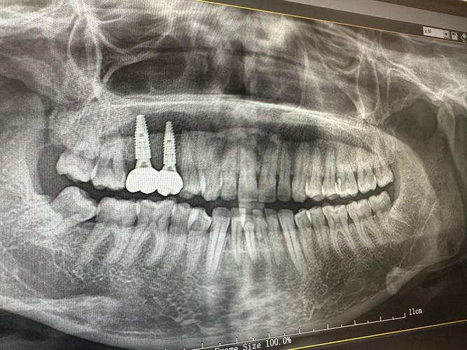 【2026年度推荐】云南刘卫国种植牙技术究竟怎么样？口碑与实力双榜单揭晓
