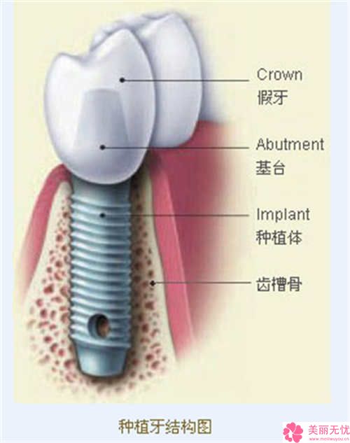 云南省玉溪市人民医院-口腔科门诊美容价钱-立得用全口种植牙1232-7399元