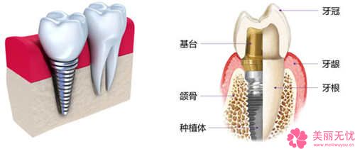 云南省玉溪市人民医院-口腔科门诊美容价钱-立得用全口种植牙1232-7399元